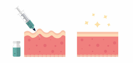 Skin with wrinkles and fine line before and after injection flat illustration. Dermatology, collagen, rejuvination concept. For topics like anti-aging therapy, biorevitalization and mesotherapy