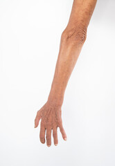 Picture of an elderly man arm with weak joint.