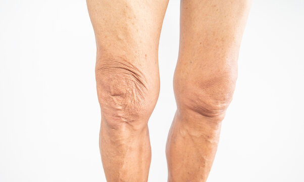 Swollen Knee Images – Browse 3,271 Stock Photos, Vectors, and Video | Adobe  Stock