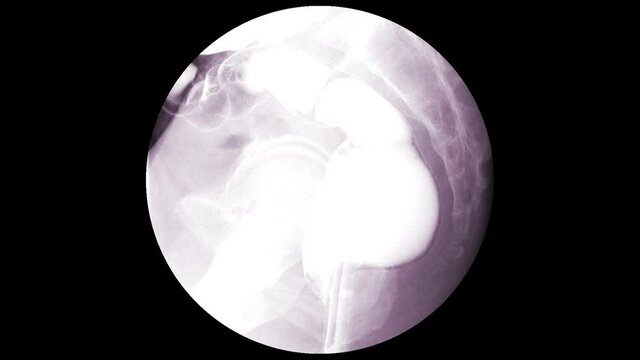 Barium enema image of large bowel after injection of barium contrast fill into colon under fluoroscopic control isolated on white background.