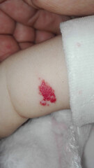 Fototapeta premium Angioma or pink hemangioma on a baby's arm
