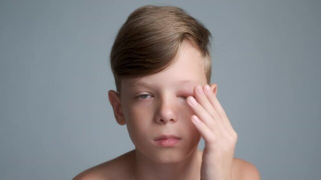 Portrait of a teen boy with a swollen eye from an insect bite. He is rubbing his eyes by hand. Allergic reaction to insect bites. Eye disease in a child, conjunctivitis, inflammation in the eye.