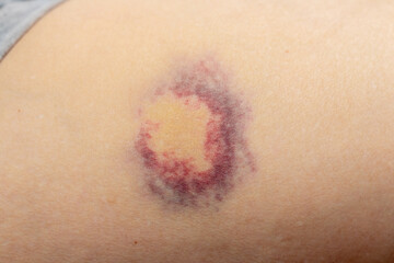 Fototapeta premium Hematoma on a woman's body as a result of violence