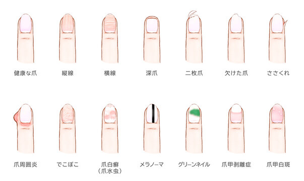 爪の病気一覧イラスト