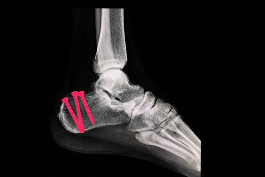 X-ray film of a frractured calcaneous after screws fixation.
