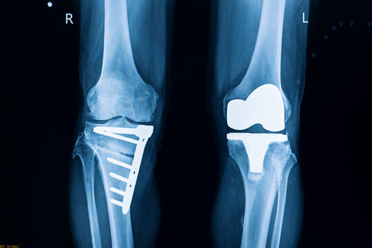 X-ray film of a patient with total left knee replacement.