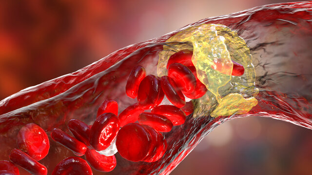 Atherosclerosis, atheromatous plaque inside artery