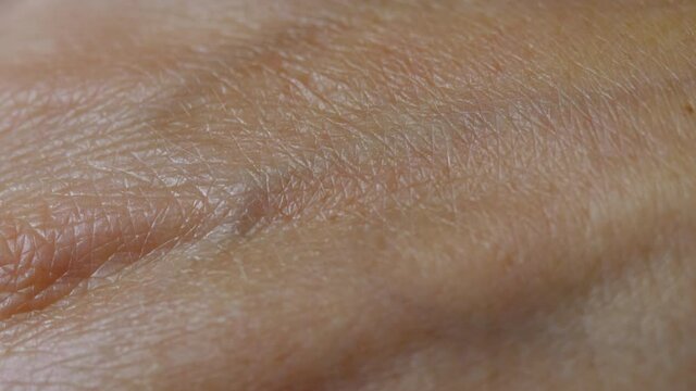 Macro Shot of Really Dry Old Human Skin. Close up Skin Texture With Wrinkles on Body Human Skin of Hand in Summer From Sunburn. Freckle Pigmentation Vein Allergy.