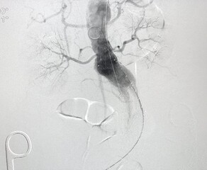 Angiogram of aorta shown Infra-renal abdominal aortic aneurysm (AAA) during endovascular aortic aneurysm repair (EVAR) procedure. - obrazy, fototapety, plakaty
