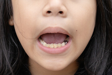 tartar on the lower teeth of a girl