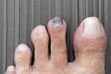Black dark toenail peeling from toe and bleeding after wearing small, tight shoes. Close up of...