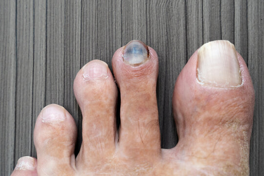 Nail Infection, Fungal (Onychomycosis) Condition, Treatments and Pictures  for Teens - Skinsight