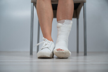 Close-up of female legs with plaster cast. A woman with a broken leg sits on a chair