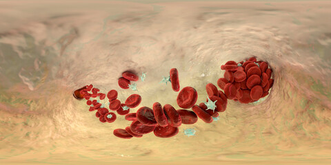 Blood clot, 360 degree panorama view - obrazy, fototapety, plakaty