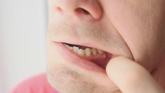 Man is showing tooth in mouth with a dental abscess fistula on gum, closeup view. Tooth with a temporary filling seal. Caries dental concept. Dental treatment of the internal parts of the tooth.