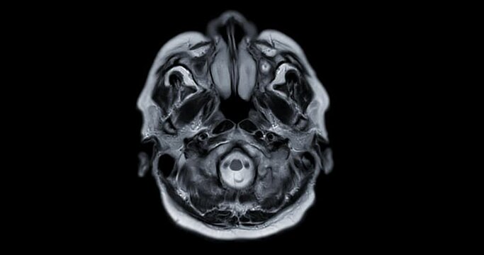 MRI Brain or Magnetic resonance imaging (MRI) of the brain in Axial  t2 for dianosis stroke disease.
