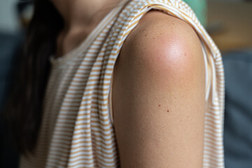 Side effect of the vaccine - shoulder skin redness and pain. Covid-19 vaccination reaction. Woman...