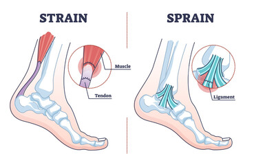 Sprain vs strain anatomical comparison as medical foot injury outline diagram. Labeled educational orthopedic muscle, tendon and ligament problem description vector illustration. Painful foot twist. - obrazy, fototapety, plakaty