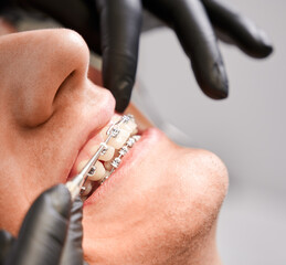 Close up of orthodontist hands in sterile gloves putting elastic rubber band on patient brackets in dental clinic. Concept of stomatology, dentistry and orthodontics.