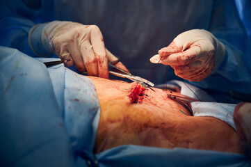 Close up of doctor hands in sterile gloves placing sutures after tummy tuck surgery. Surgeon performing abdominal plastic surgery in operating room. Concept of abdominoplasty and aesthetic surgery.