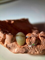 Tooth for dental crown placement.