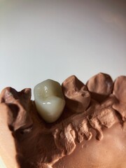 Tooth for dental crown placement.