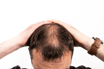 Obraz premium Close-up balding head of a young man on a white isolated background.