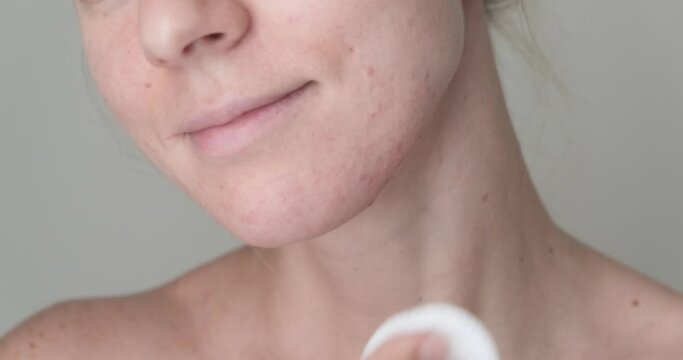 Close up of woman applying skin care product with cotton pad on her chin with acne and problematic skin. 