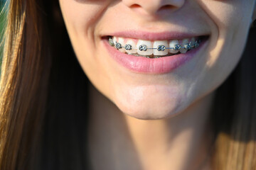 Close-up dental braces on teeth. Orthodontic Treatment. Dental care Concept.