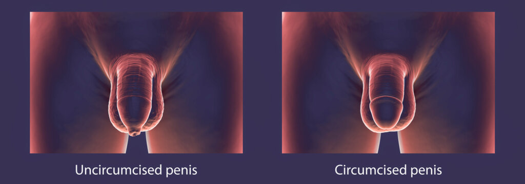 Circumcised and uncircumcised penis, illustration