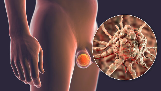 Testicular cancer, 3D illustration