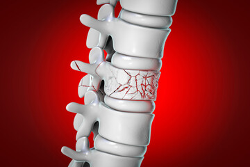 Spinal fracture, traumatic vertebral injury - obrazy, fototapety, plakaty