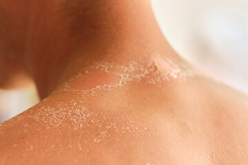 unrecognizable guy got sunburn and got tan lines on his back. The skin sloughs off it is burn skin. It looks ugly. He has a burning pain on his shoulder. He get burning pain.