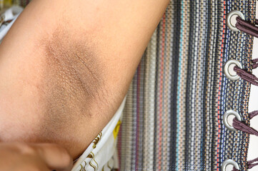 Close up black armpit effect from pregnancy women. skin care and beauty concept.long armpit hair