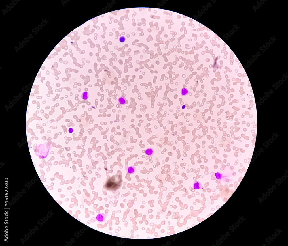 Poster blood picture of acute myeloid leukemia (aml), analyze by microscope