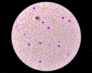Blood picture of acute myeloid leukemia (AML), analyze by microscope