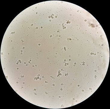 Sperm or semen test or analysis. Azoospermia with plenty pus cells seen. infertily. no sperm