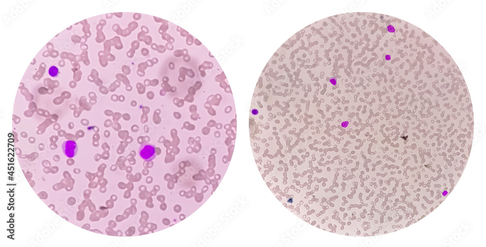 Canvas Prints blood picture of acute myeloid leukemia (aml), analyze by microscope