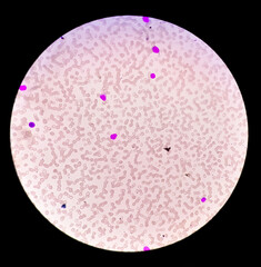 Blood picture of acute myeloid leukemia (AML), analyze by microscope