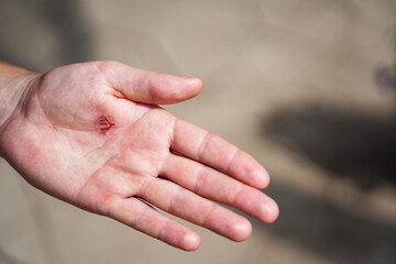 Torn callus of the hand close-up. Rough skin of male hand.