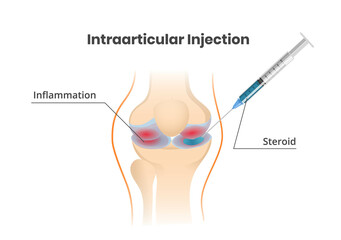 Knee joint injection. Injection of the corticosteroids scientific illustration