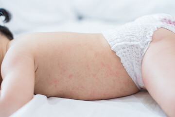 baby rash skin, prickly heat on baby (selective focus)	