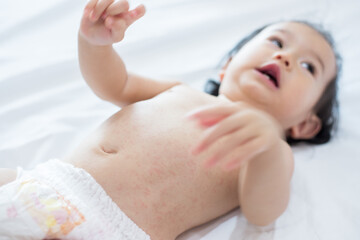 Obraz na płótnie Canvas baby rash skin, prickly heat on baby (selective focus) 