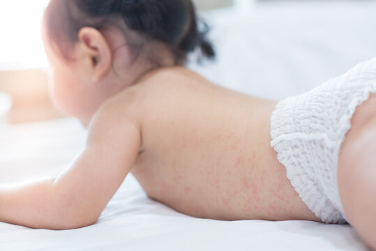 baby rash skin, prickly heat on baby (selective focus)	