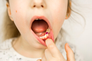 Colored purple filling on the girl's milk chewing tooth. Pediatric dentistry, treatment and examination. A child with an open mouth shows a tooth in close-up on a white background.
