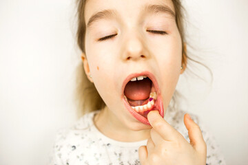 Colored purple filling on the girl's milk chewing tooth. Pediatric dentistry, treatment and examination. A child with an open mouth shows a tooth in close-up on a white background.