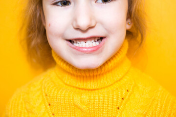Girl shows her teeth-pathological bite, malocclusion, overbite. Pediatric dentistry and...