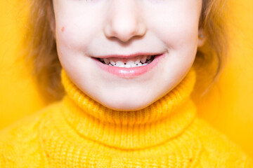 Girl shows her teeth-pathological bite, malocclusion, overbite. Pediatric dentistry and periodontics, bite correction. Health and care of teeth, caries treatment, baby teeth. Upper jaw rests on gum. - obrazy, fototapety, plakaty