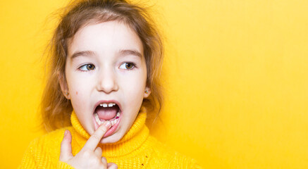 Colored purple filling on the girl's milk chewing tooth. Pediatric dentistry, treatment and examination. A child with an open mouth shows a tooth in close-up on a yellow background.