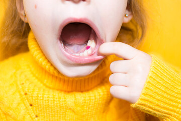 Colored purple filling on the girl's milk chewing tooth. Pediatric dentistry, treatment and...
